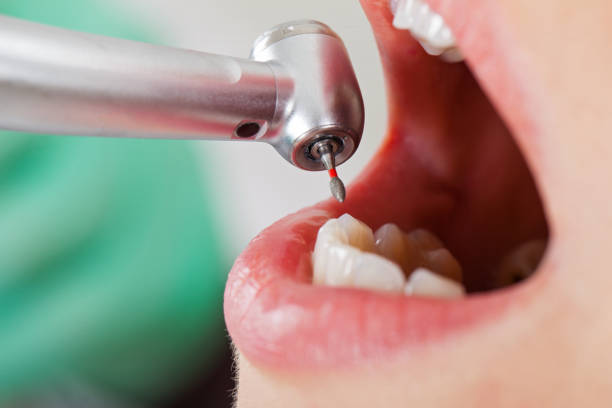 Best Emergency Wisdom Teeth Removal in Lake Kiowa, TX